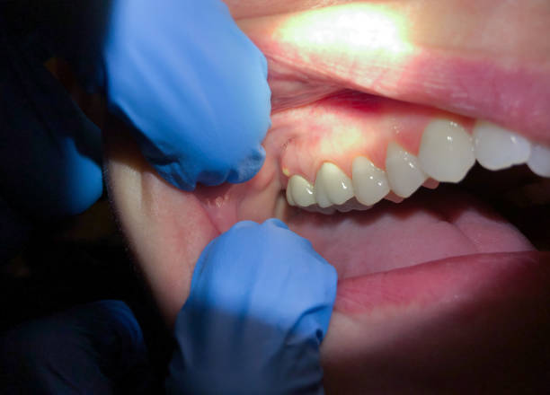 Best Dentist for Tooth Abscess  in Glenpool, OK